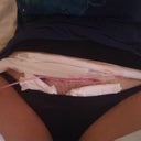 Post op day 1