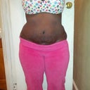 10 week p.o. front view swelling above incision & right side.