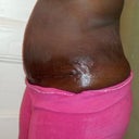 10 wk p.o. left side view of scar