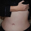 2 months, 2 weeks and 4 days post op