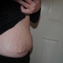 Strange ridge above my incision on the right hand side...