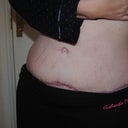 Worst bit of my scar (looks even worse because of the flash) at 2 months, 2 weeks and 4 days...