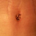 3wks 1 day po...before getting bb stitches out