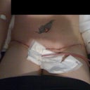 This was taken 2 days after surgery