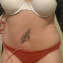 10 days post op