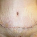 PO Day 7 with all the tape removed