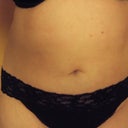 Lower abs after 5 treatments - post-hysterectomy pooch almost gone!