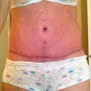 Full frontal.  Not really.  Scar is healing nicely.