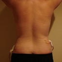 one week post opt 10-19-2010