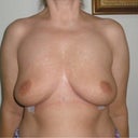 24 hours after explant, full frontal.