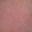 My Strech marks