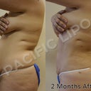 A before and after side view from my Doc's office
