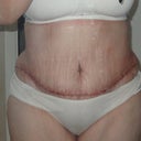 post op day 18