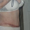 scar is a little ugly still