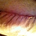 the scar is swollen look how bad it puckers