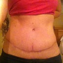 Sorry not a great pic.  My scar has been red/purplish lately.  I'm consistent about massage with Bio Oil still