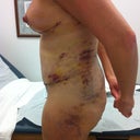 Day 8 PO. Side view of belly, flanks and thigh. Incision is a bit irritated from binder sliding around.