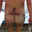Day 8 PO. Lower back, hips, flanks and thighs are still pretty swollen.