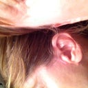 Front scarring. Also, have back of ear scarring from the cut around the ear lobes.