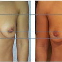 Comparison 1 month after OP (left) with 2 weeks after  (right)