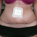 Day 15 PO still very swollen and circular plaster is where they syringed me