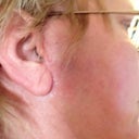 Rt ear, you can hardly see the scar.