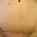 6 Months PO