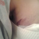 right side bruise