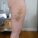 Day 5 - My right side is much less bruised than my left