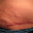 Very Painful 6 Months Post