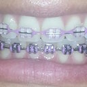 Lilac colored ligatures just for fun while I still have my braces on. 17 months into treatment. Some of my teeth were contoured to straighten out some of the edges.