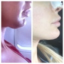 Chin Lipo: Wow beyond my expectations! I guess I should have done it awhile ago $1600.. Worth it!