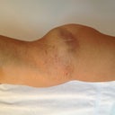 1 day post op side view