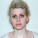 3.2 months post-op  (I used a temporary lip plumper to get lips like this)