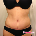 5 weeks po, no drain!!