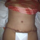 PostOp Pic Day 28.  Still lots of swelling around the incision and hips area.  The scar looks darker than it really is in this pic. My PS said the wrinkling will work itself out as the swelling goes down and stitches dissolve.