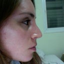 7 weeks post-op