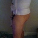 Post op Side view