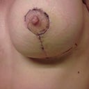 2 Weeks Post Op LEFT BREAST - This ones more settled then other.