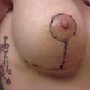 2 Weeks Post Op RIGHT BREAST - Little more higher but feeling it starting to go down.