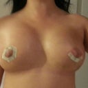Here are my boobs a week and a half out almost.  You can see how swollen they still are but how nice the cleavage is going to be!