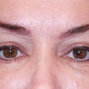 24 hours after Juvaderm injection.  I feel great about the result.  Virtually no swelling, no bruising except tiny needle marks.  Wow, Jennifer was good.