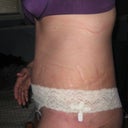 side view at almost 3 weeks. tons of swelling and bruising but see small improvments...