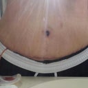 day 9 post op