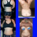 Two weeks post op