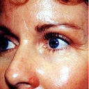 Cheek Augmentation