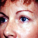Cheek Augmentation