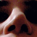 After first rhinoplasty, before revision. Nose goes to one side.