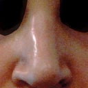 After first rhinoplasty, before revision. Collapsed on one side.