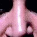 After first rhinoplasty, before revision. You can see how low one side of my tip is compared to the other.